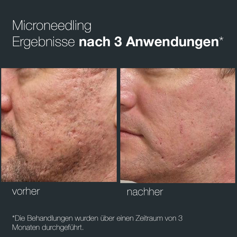 Pro Microneedling Pen 2 - Angebot